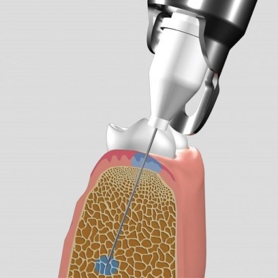 골내마취기 &ndash; 마취가 잘 안되는 분들에게 효과적인 무통마취 관련 이미지 4
