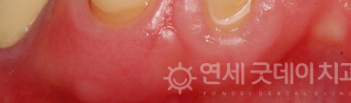 치과 잇몸치료 비용? 엠도게인 잇몸재생 사례 관련 이미지 37