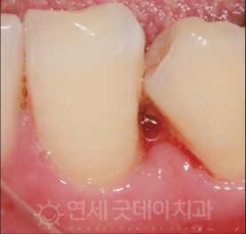 치과 잇몸치료 비용? 엠도게인 잇몸재생 사례 관련 이미지 10
