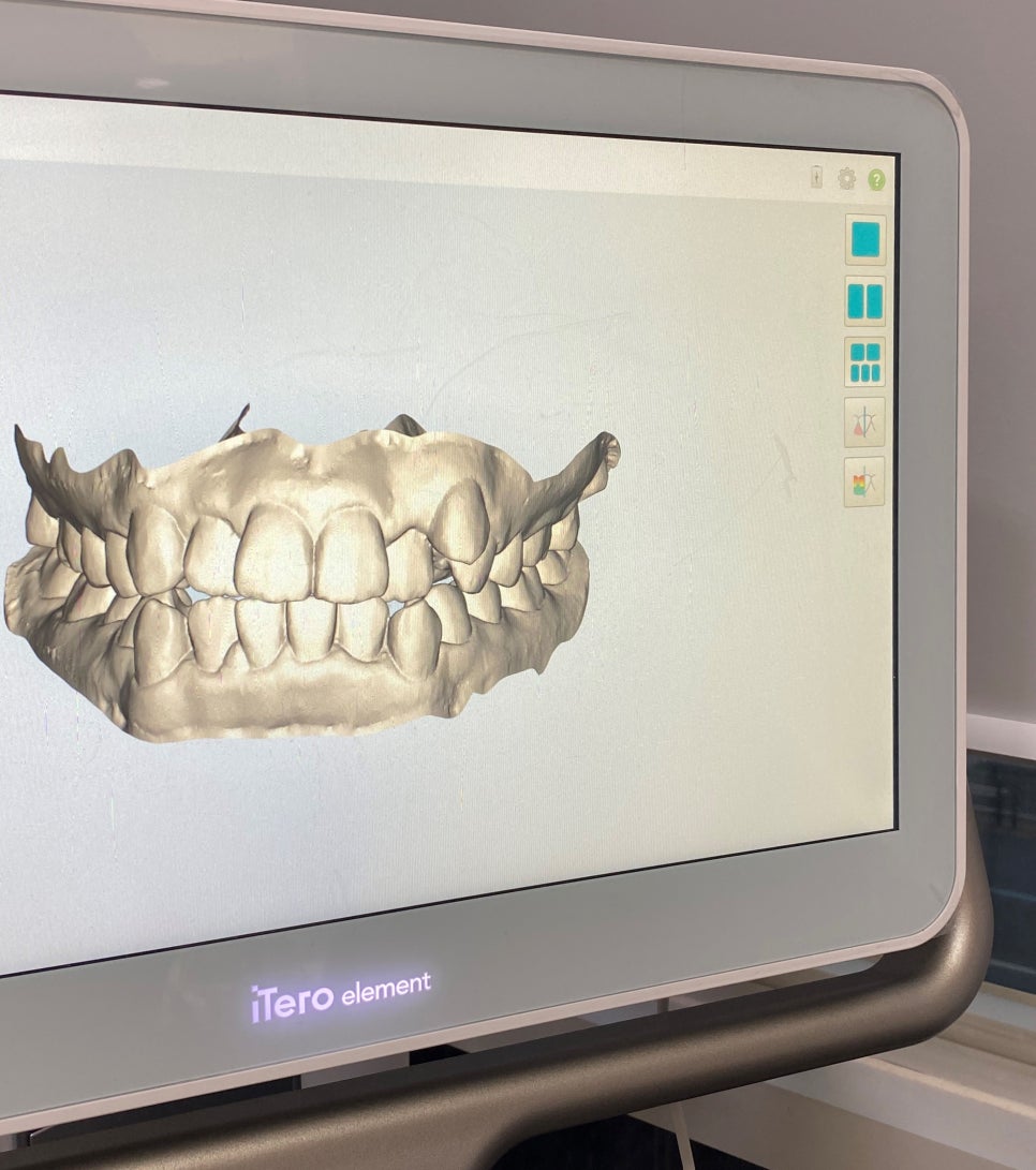 아이테로(iTero) 구강스캐너로 교정전후 시뮬레이션 결과를 확인하실 수 있습니다. 관련 이미지 5