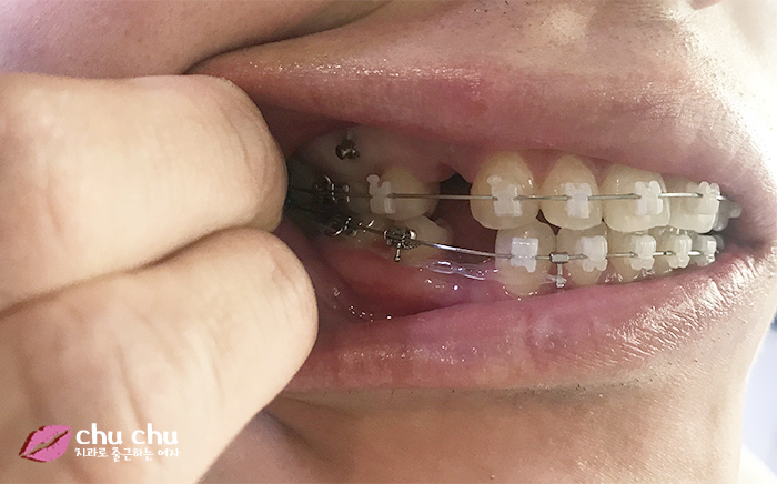 치아교정후기 2년간의 과정, 얼굴변화 (with 굿데이치과) 관련 이미지 5