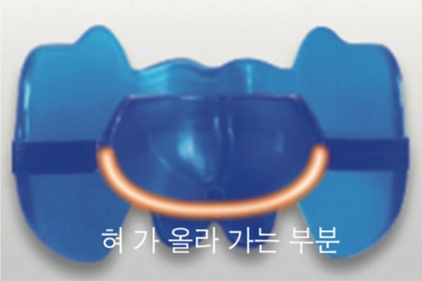 프리올소 장치안내 (ft. 어린이 부정교합 교정 편) 관련 이미지 11