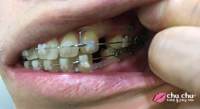 [ 교정4개월 ] 치아교정 파워체인 상/하악 모두 완료 관련 이미지 1