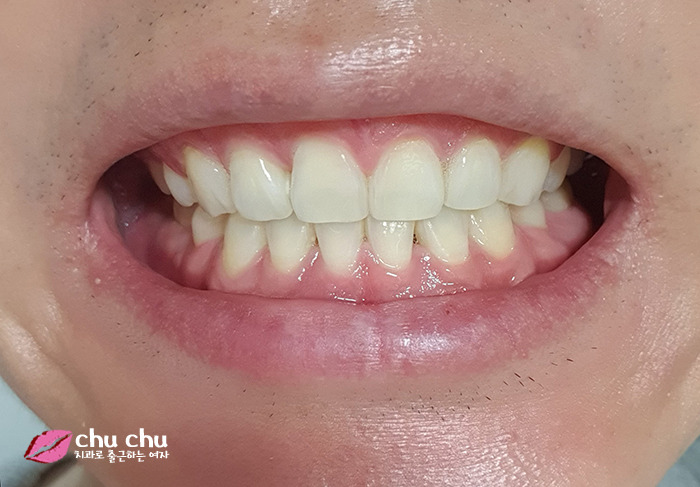 치아교정후기 2년간의 과정, 얼굴변화 (with 굿데이치과) 관련 이미지 11