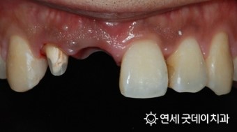 올 해 7월부터 65세 이상 어르신 틀니, 임플란트 보험 적용 ( 2016년 7월 1일부터 ) 관련 이미지 4