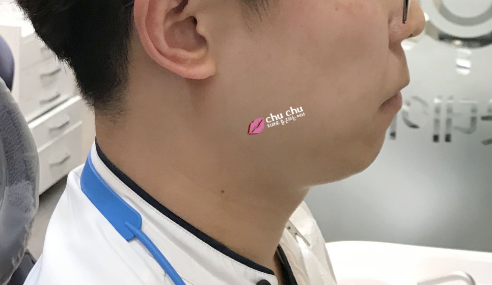 남자 돌출입교정일기 놀라운 변화! (1년, 365일 경과) 관련 이미지 1