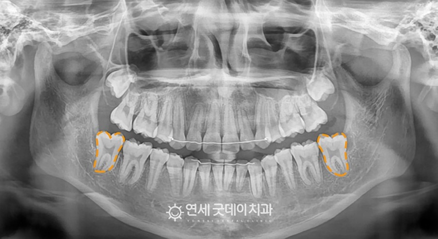 매복치아 견인교정 (feat. 구강외과 전문의 협진) 관련 이미지 8