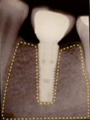 아스트라 임플란트(Astra implant) &ndash; 스웨덴산과 국산의 차이점!? 관련 이미지 3