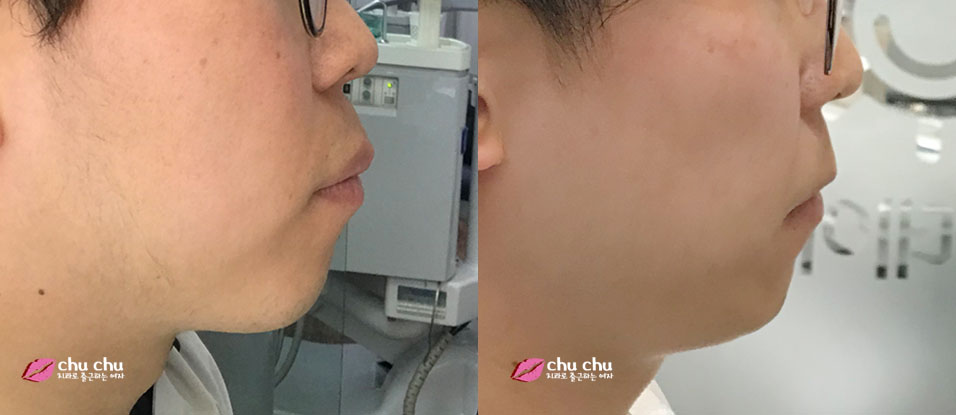 남자 돌출입교정일기 놀라운 변화! (1년, 365일 경과) 관련 이미지 2