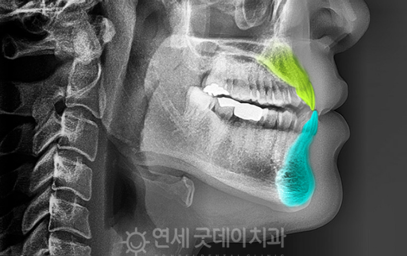 반대교합 교정 (30대 남성, 비발치) 관련 이미지 3