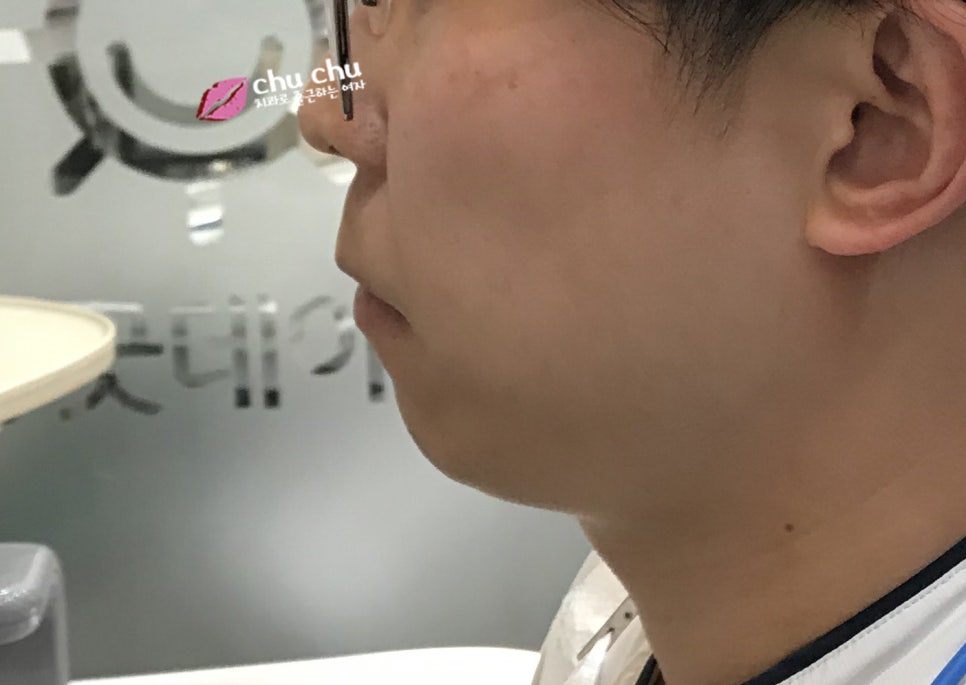 튀어나온 입 변화과정 (2018.03 ~) 관련 이미지 6