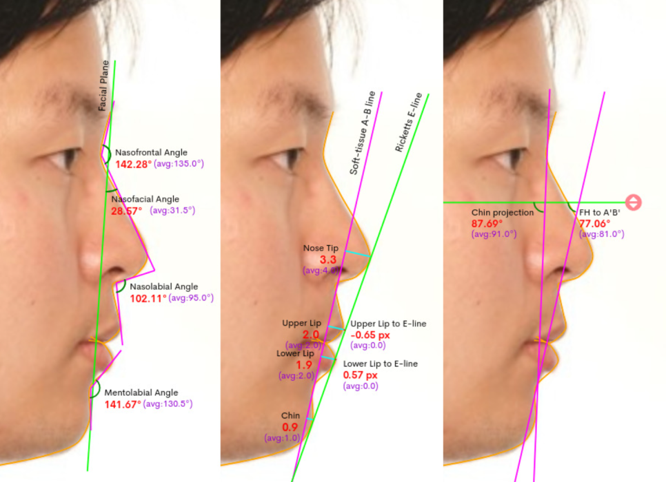Yonsei Good Day Dental Clinic Operates WebCeph Diagnostics to Predict Pre- and Post-Orthodontic Changes image 4