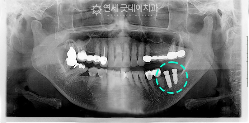 연세굿데이치과, 18년 장기보존 임플란트 증례발표 관련 이미지 1
