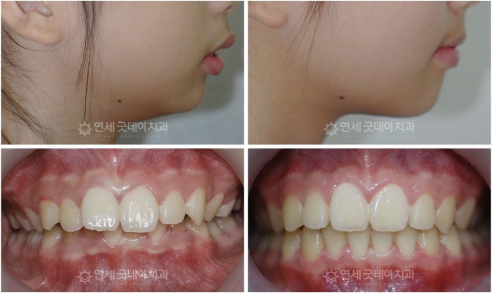 연세굿데이치과] 성장판 검사가 중요한 이유 관련 이미지 6