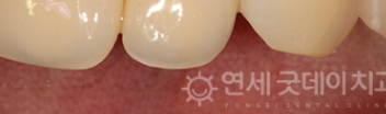 치과 잇몸치료 비용? 엠도게인 잇몸재생 사례 관련 이미지 19