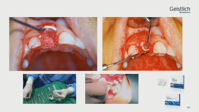 [Dr.정재욱] 치조제보존술(ARP) 유튜브 실시간 온라인강연 관련 이미지 18
