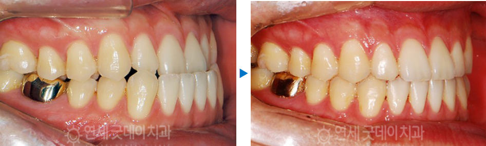 반대교합 교정 (30대 남성, 비발치) 관련 이미지 12