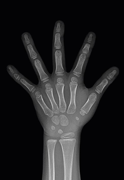 연세굿데이치과] 성장판 검사가 중요한 이유 관련 이미지 2