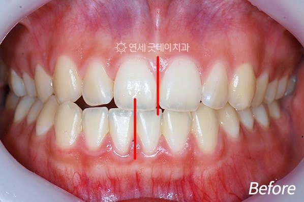 치아중심선 비대칭 교정 관련 이미지 8