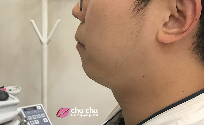 치아교정후기 2년간의 과정, 얼굴변화 (with 굿데이치과) 관련 이미지 7