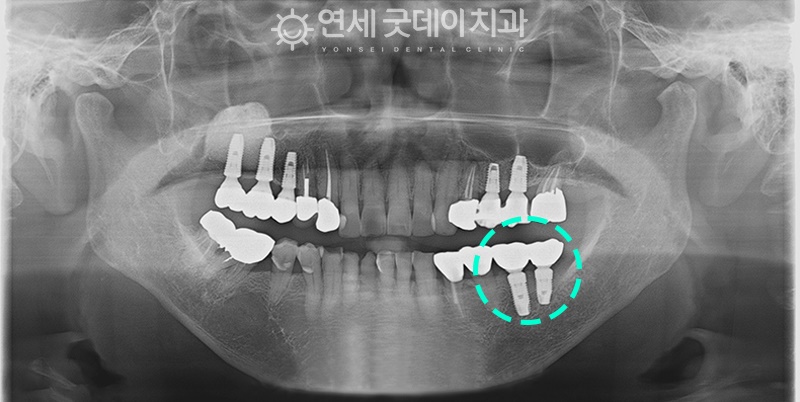 연세굿데이치과, 18년 장기보존 임플란트 증례발표 관련 이미지 8