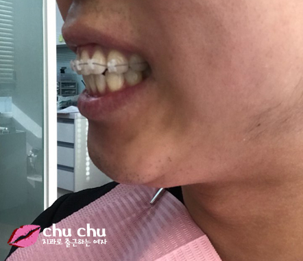 [ 연세굿데이 교정 ] 우리 직원이 달라졌어요 - 돌출입치아교정 start 관련 이미지 7