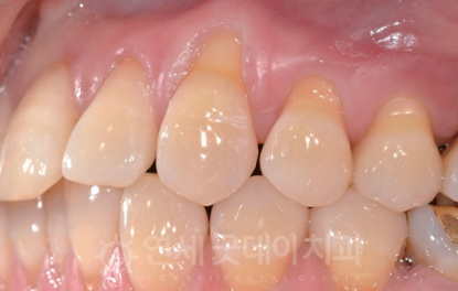 치과 잇몸치료 비용? 엠도게인 잇몸재생 사례 관련 이미지 5