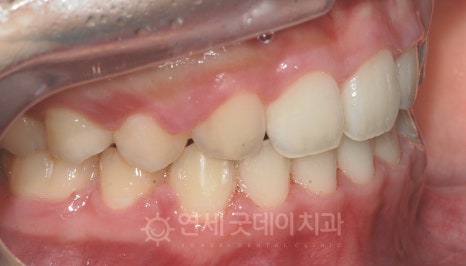 돌출입 무턱 치아교정 (15세 중학생) 관련 이미지 10