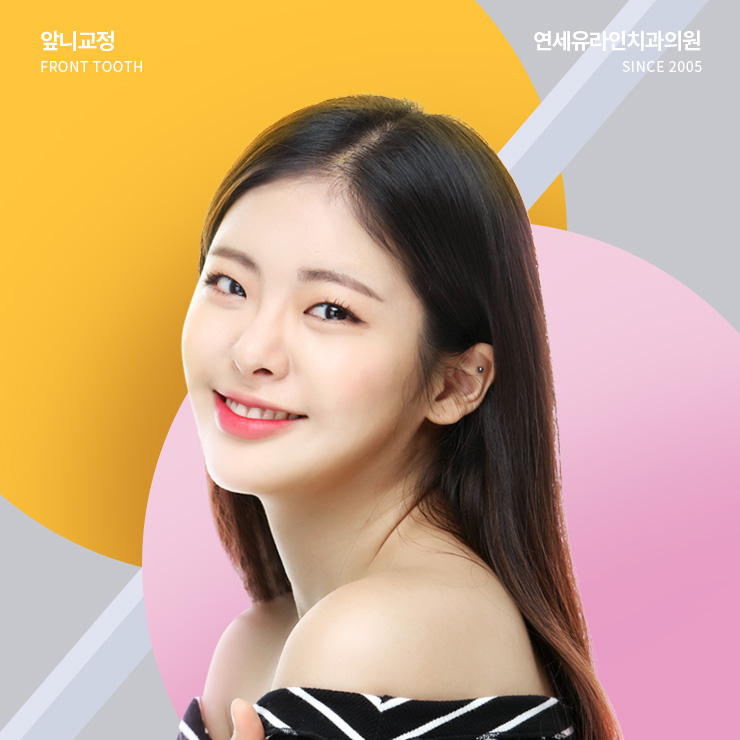 동작구치과 부담스럽지 않은 앞니 개선 관련 이미지 1