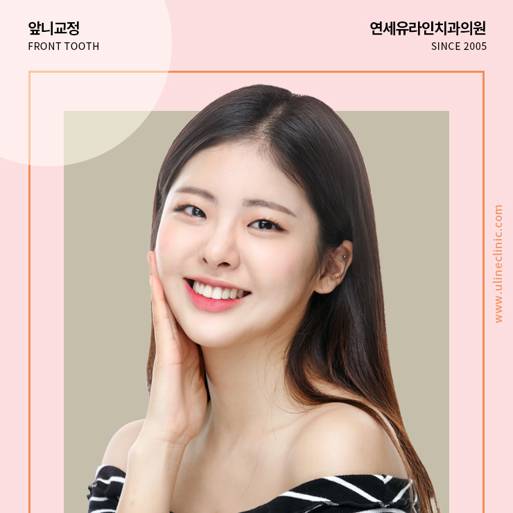 돌출앞니교정 함으로써 행복 뿜뿜 관련 이미지 1