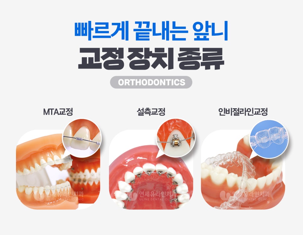 앞니부분교정기간 눈 깜짝 할 사이에! 관련 이미지 4