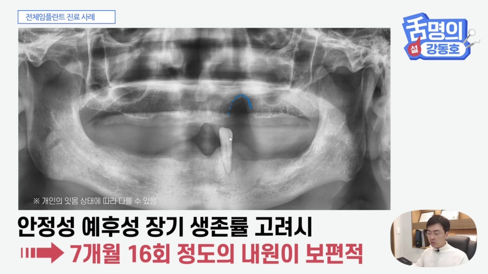 관악구치과 - 전체 임플란트, 시간&middot;횟수&middot;개수 총정리 관련 이미지 9