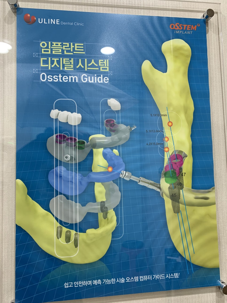 임플란트이용틀니 가격 가장 주목받고 있죠 관련 이미지 2
