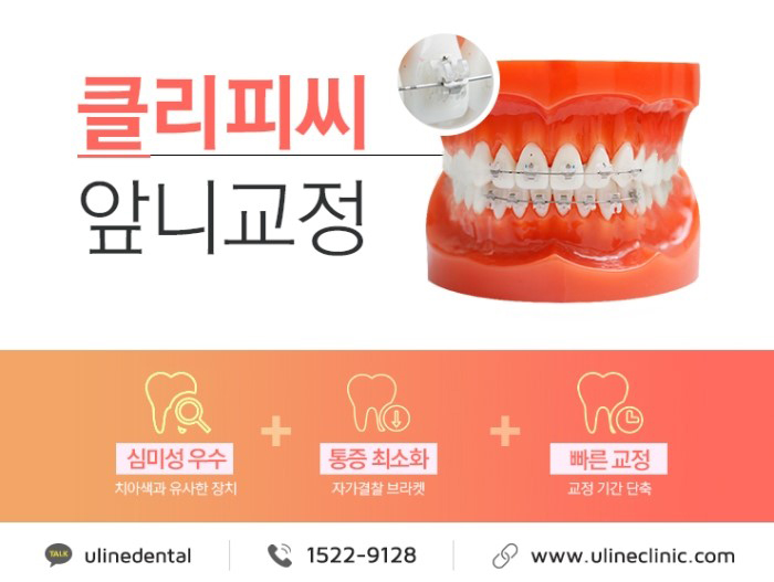 앞니교정후기 토끼이빨 같았던 내모습이 변했다 관련 이미지 6