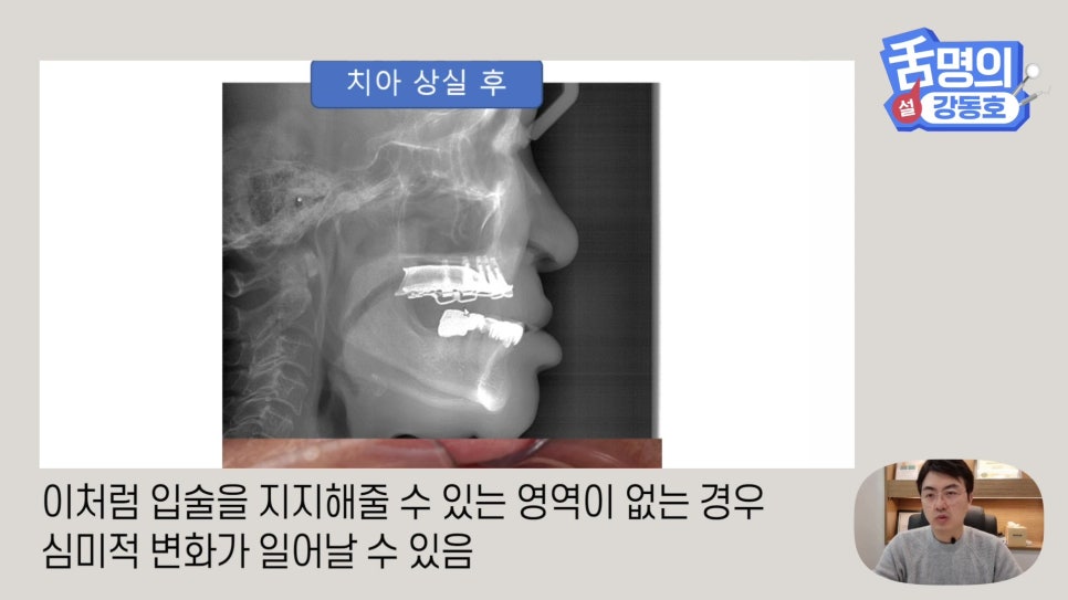 Dental Implants at Sillim Station: When There Is Not Enough Jawbone image 4