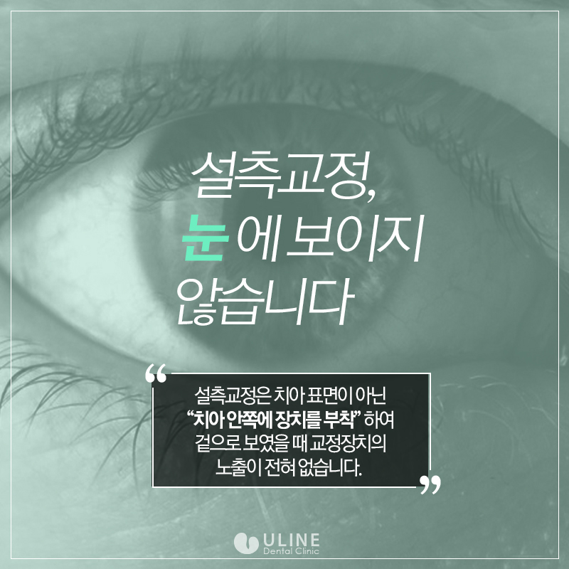 설측교정후기 제대로 알고 스타트! 관련 이미지 6