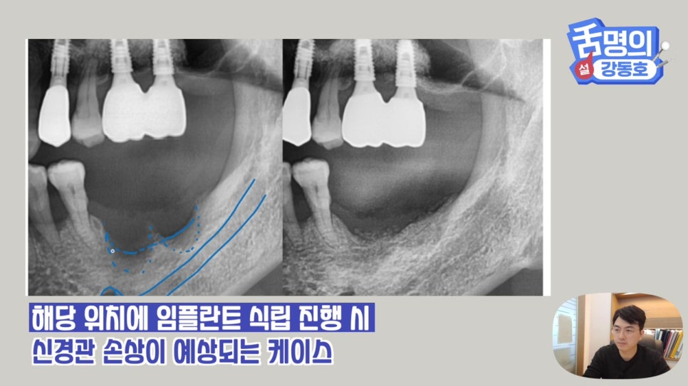 강남역임플란트, 뼈이식 왜 필요해? 관련 이미지 20
