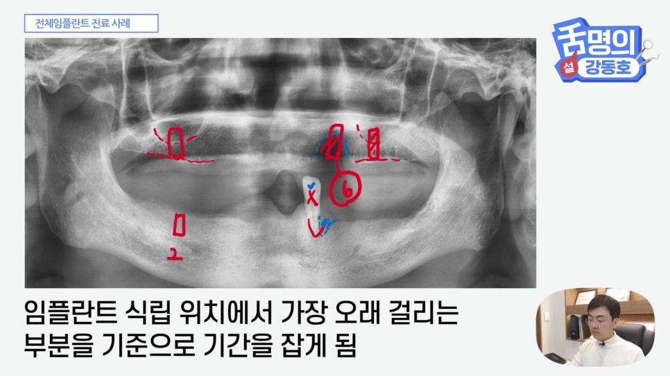 관악구치과 - 전체 임플란트, 시간&middot;횟수&middot;개수 총정리 관련 이미지 13