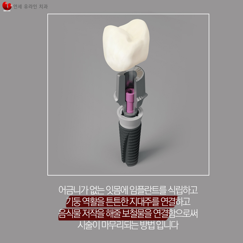 어금니임플란트가격 걱정을 내려줄 관련 이미지 3