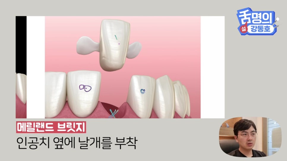 신림동치과, 브릿지치료 치아삭제 부담된다면? 관련 이미지 18