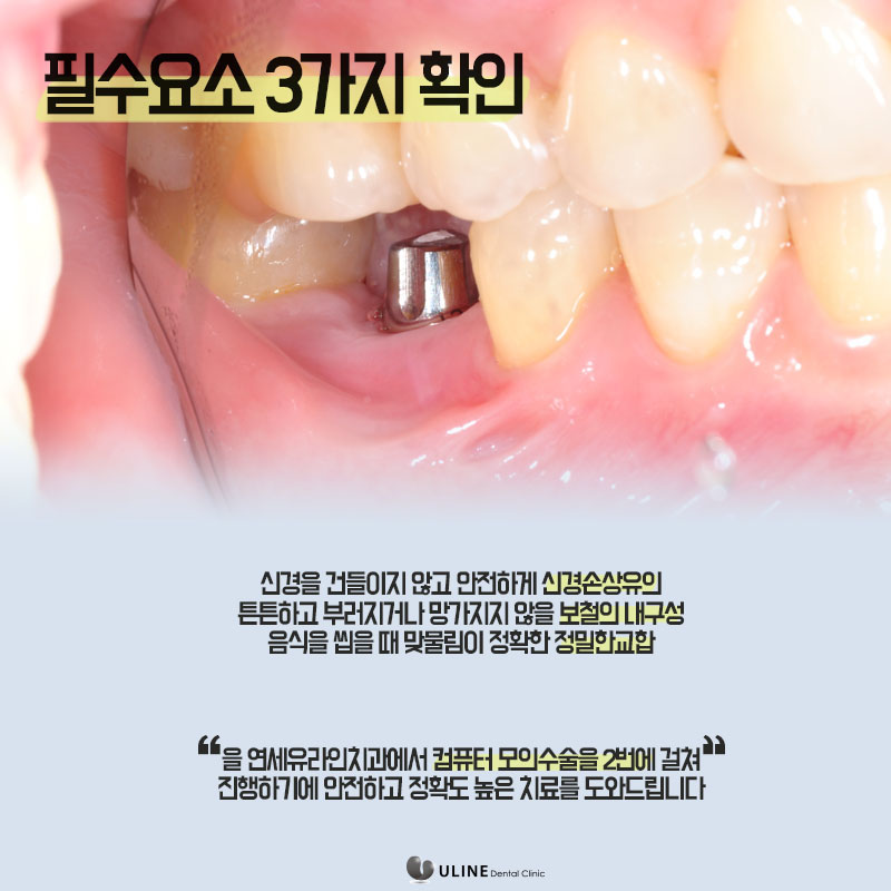 어금니임플란트통증 모두 줄였다! 관련 이미지 6