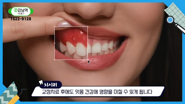 Do Braces Weaken Your Gums? A Fact Check by a Sinlim Dental Clinic image 15