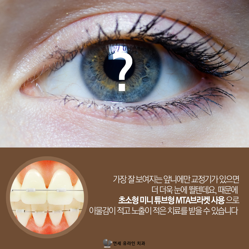 벌어진앞니교정 콤플렉스 빠이! 관련 이미지 9