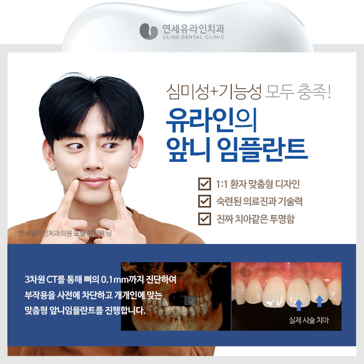 앞니임플란트가격 좋은예후를 기대하러 관련 이미지 6