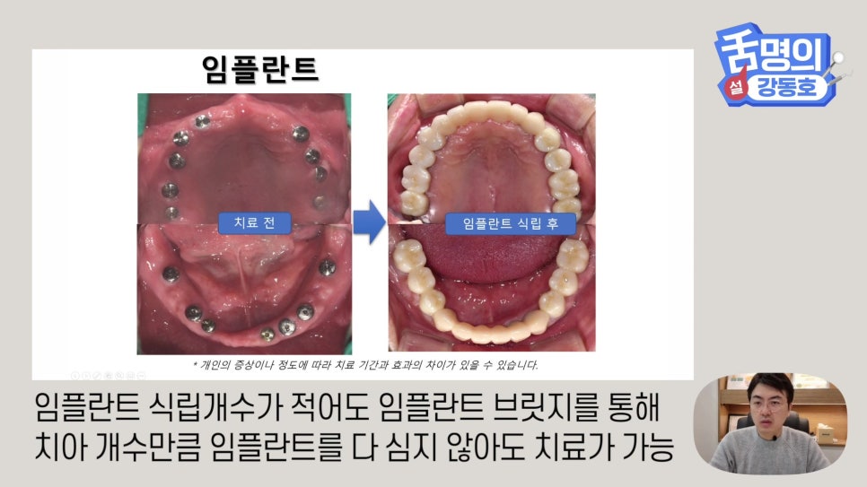 Dental Implants at Sillim Station: When There Is Not Enough Jawbone image 12