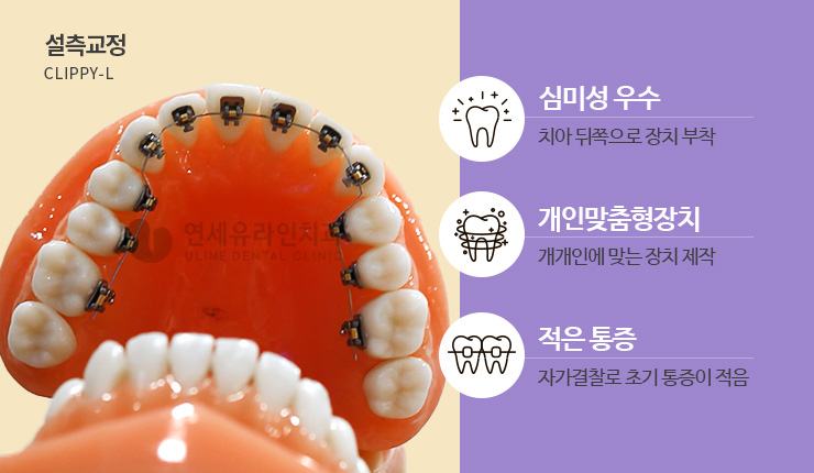 설측교정가격 하나의 우수한 심미 개선안 관련 이미지 6