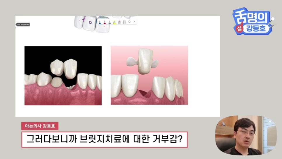 신림동치과, 브릿지치료 치아삭제 부담된다면? 관련 이미지 4
