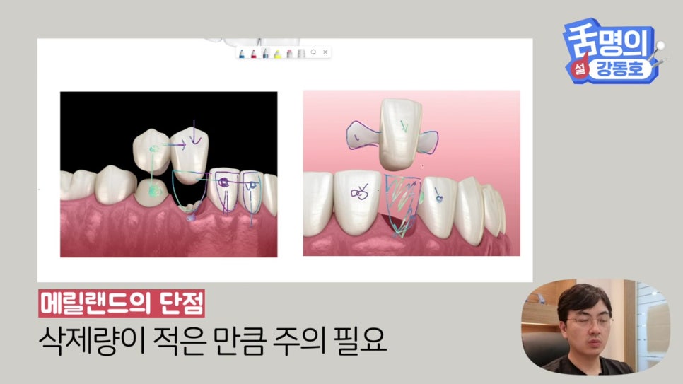 신림동치과, 브릿지치료 치아삭제 부담된다면? 관련 이미지 20