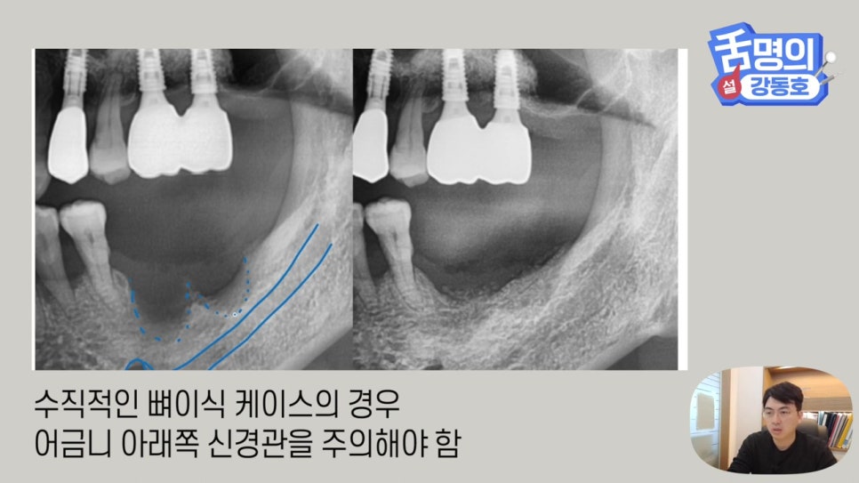 강남역임플란트, 뼈이식 왜 필요해? 관련 이미지 19