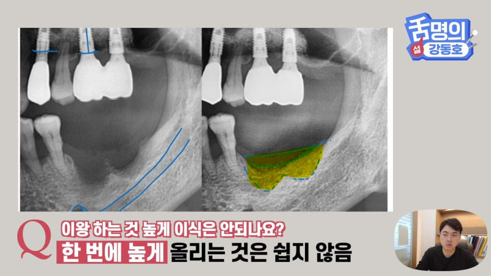 강남역임플란트, 뼈이식 왜 필요해? 관련 이미지 23